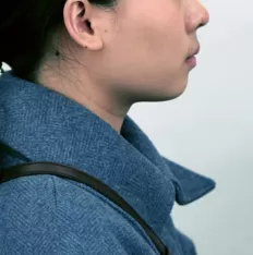 Facial photos before treatment