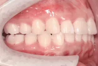 Intraoral photos after treatment