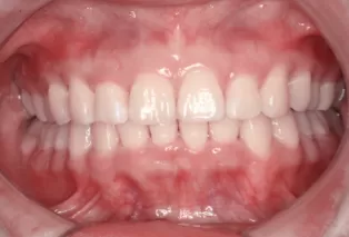Intraoral photos after treatment