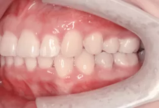 Intraoral photos after treatment