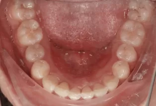 Intraoral photos after treatment