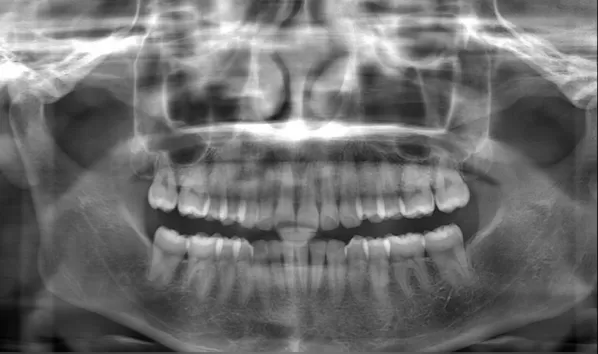 X-rays before treatment