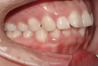 Intraoral photos
