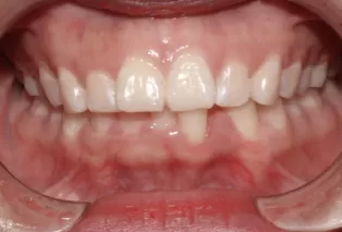 Intraoral photos