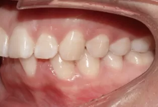 Intraoral photos