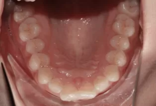 Intraoral photos