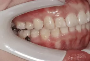 Intraoral photos