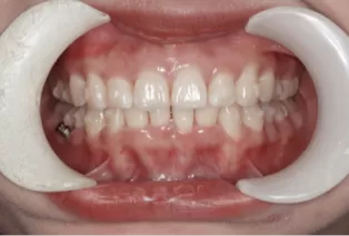 Intraoral photos
