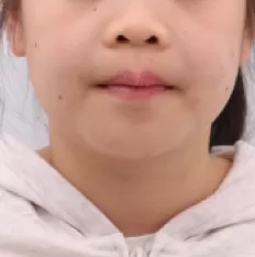 Facial photos before treatment