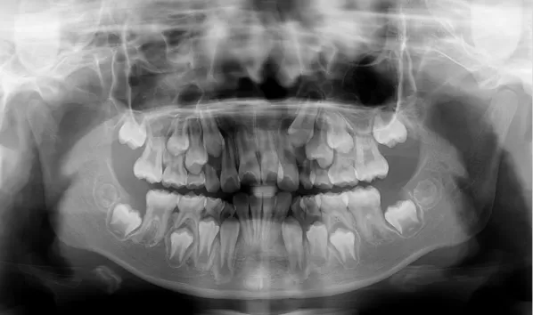 X-rays before treatment