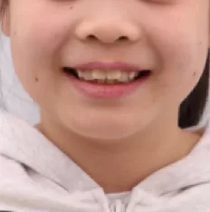 Facial photos before treatment