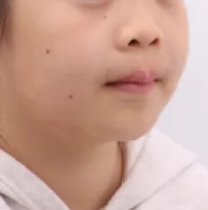 Facial photos before treatment