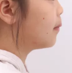 Facial photos before treatment