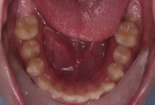 Intraoral photos