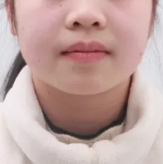 Facial photos before treatment