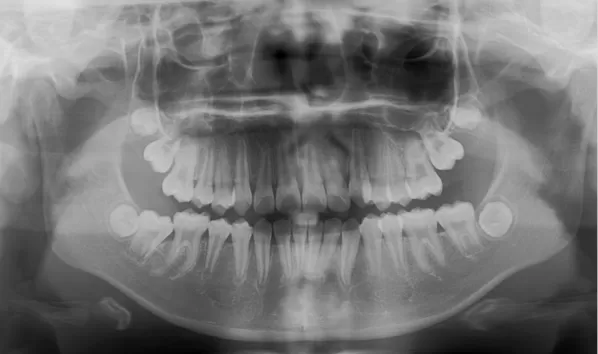 X-rays before treatment