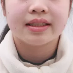 Facial photos before treatment