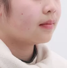 Facial photos before treatment