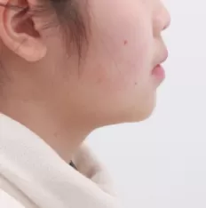 Facial photos before treatment