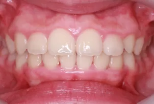 Intraoral photos after treatment
