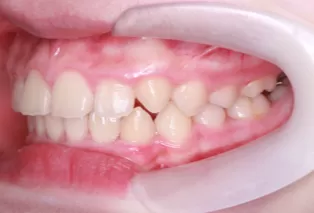 Intraoral photos after treatment