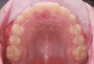 Intraoral photos after treatment