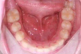 Intraoral photos after treatment
