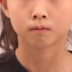 Facial photos before treatment