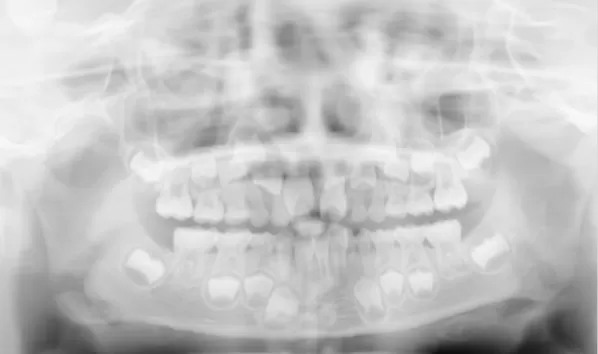 X-rays before treatment