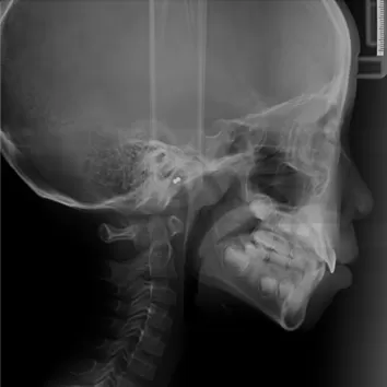 X-rays before treatment