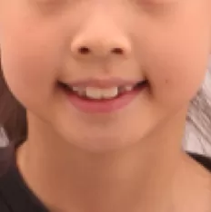 Facial photos before treatment