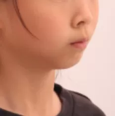 Facial photos before treatment