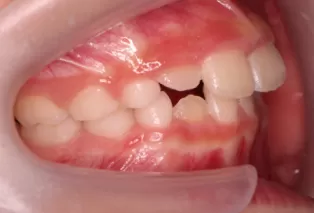 Intraoral photos