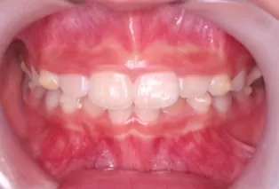 Intraoral photos