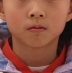 Facial photos before treatment