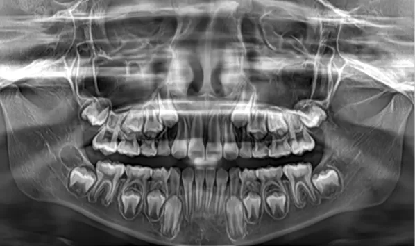 X-rays before treatment