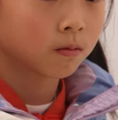 Facial photos before treatment