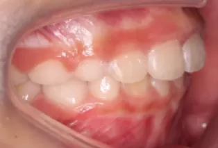 Intraoral photos after treatment