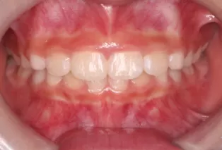 Intraoral photos after treatment