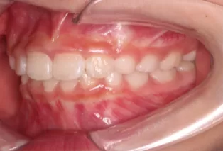 Intraoral photos after treatment