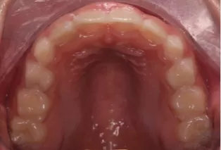 Intraoral photos after treatment