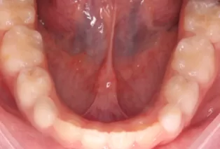 Intraoral photos after treatment