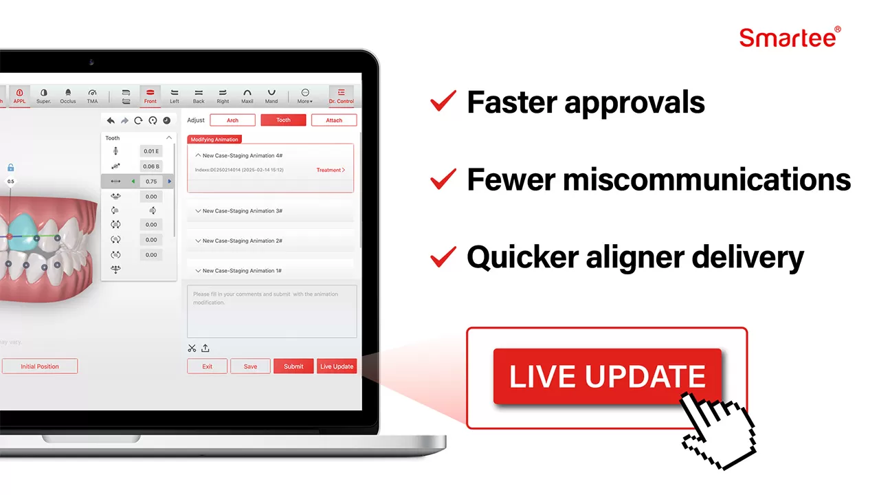 Smartee Unveils ‘Live Update’ to Slash Treatment Planning Time from Days to Seconds